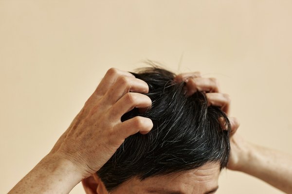 Eczéma cuir chevelu : causes et solutions naturelles à découvrir